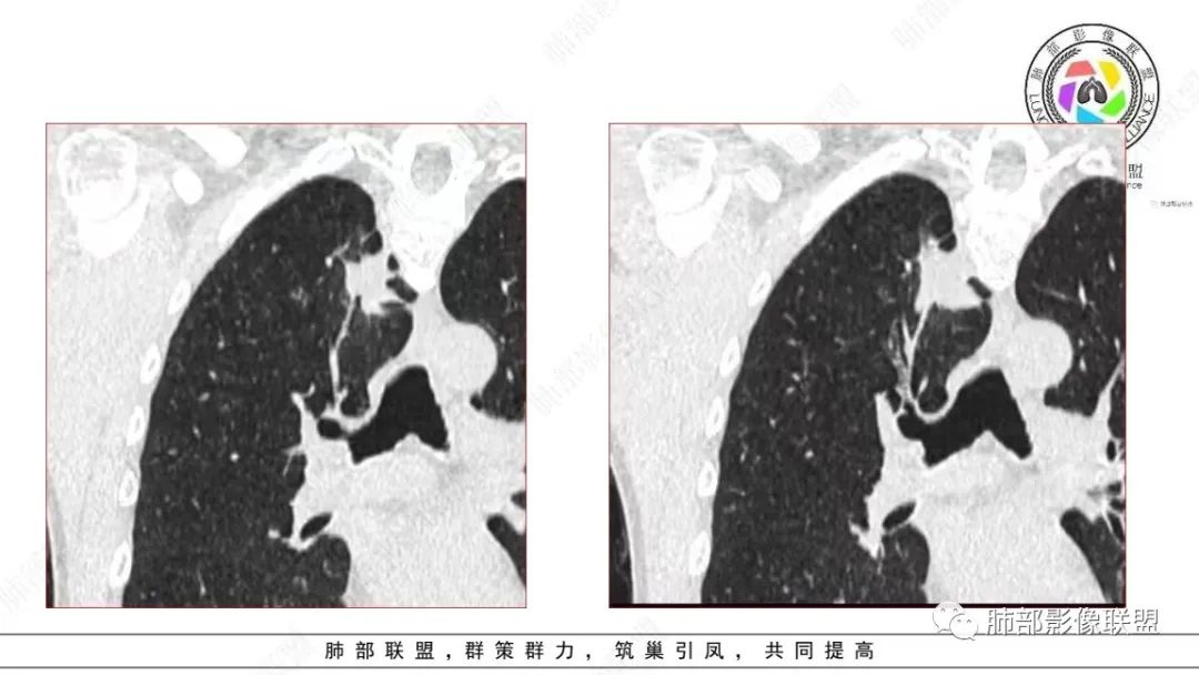 影像PPT - 【病例】少见的细支气管腺瘤1例CT影像-9 影像PPT - 【病例】少见的细支气管腺瘤1例CT影像-9