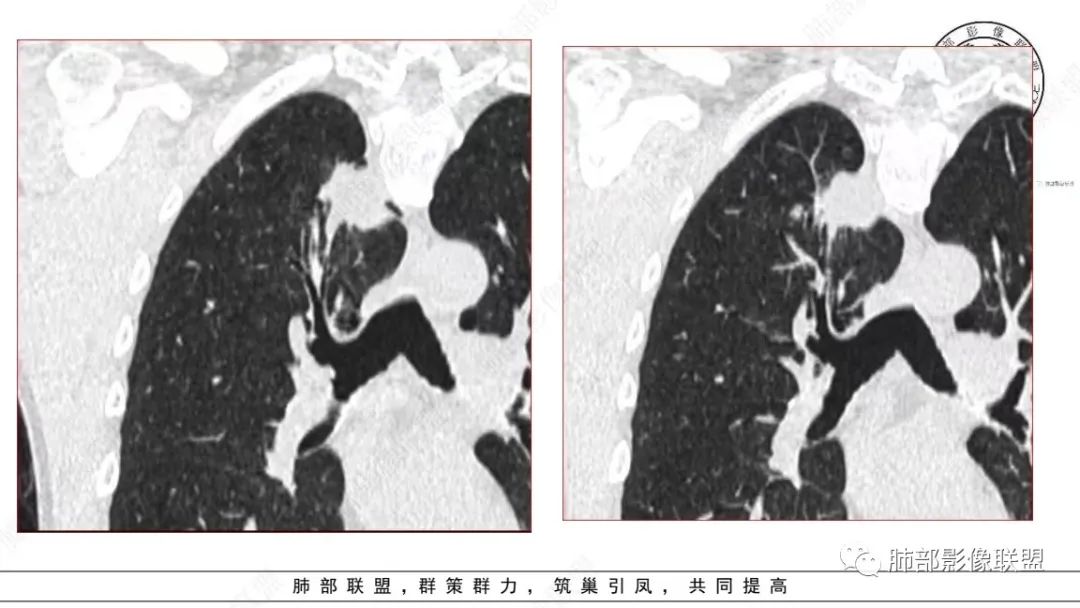 影像PPT - 【病例】少见的细支气管腺瘤1例CT影像-10 影像PPT - 【病例】少见的细支气管腺瘤1例CT影像-10