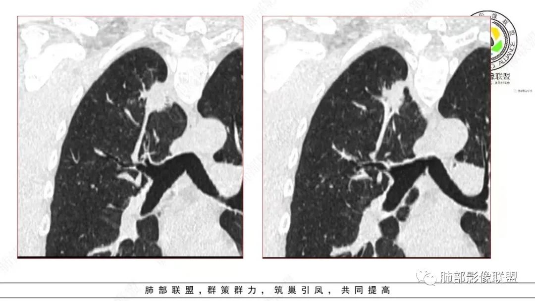 影像PPT - 【病例】少见的细支气管腺瘤1例CT影像-11 影像PPT - 【病例】少见的细支气管腺瘤1例CT影像-11