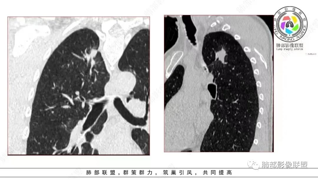 影像PPT - 【病例】少见的细支气管腺瘤1例CT影像-12 影像PPT - 【病例】少见的细支气管腺瘤1例CT影像-12
