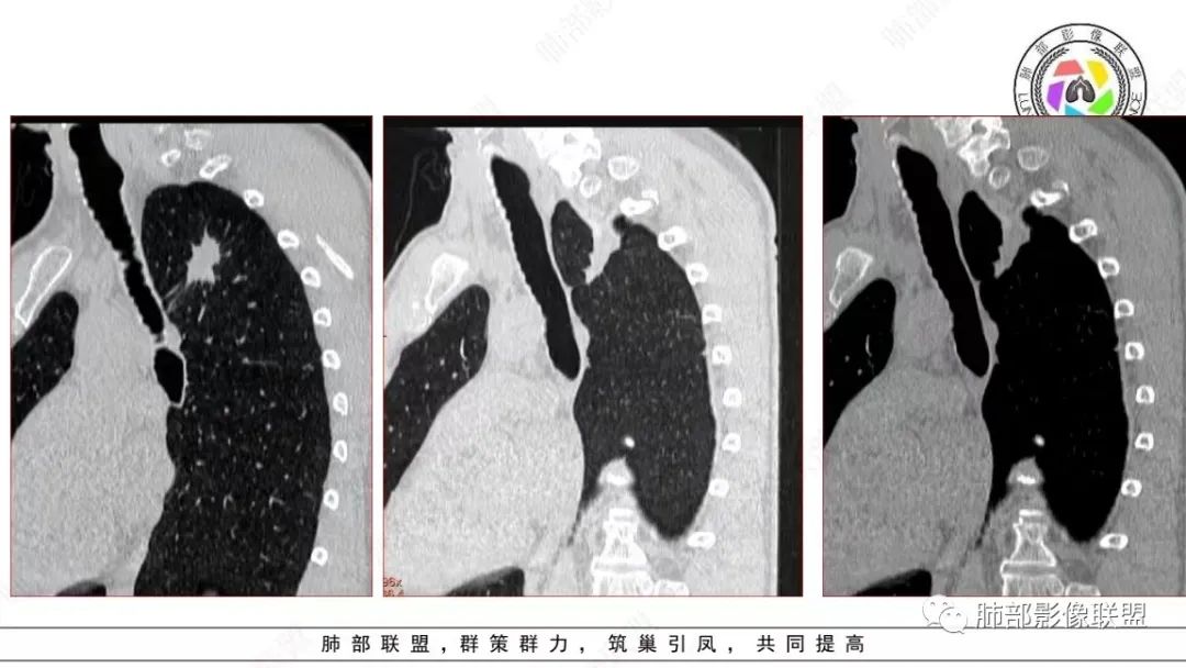 影像PPT - 【病例】少见的细支气管腺瘤1例CT影像-14 影像PPT - 【病例】少见的细支气管腺瘤1例CT影像-14