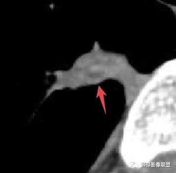 影像PPT - 【病例】少见的细支气管腺瘤1例CT影像-25 影像PPT - 【病例】少见的细支气管腺瘤1例CT影像-25