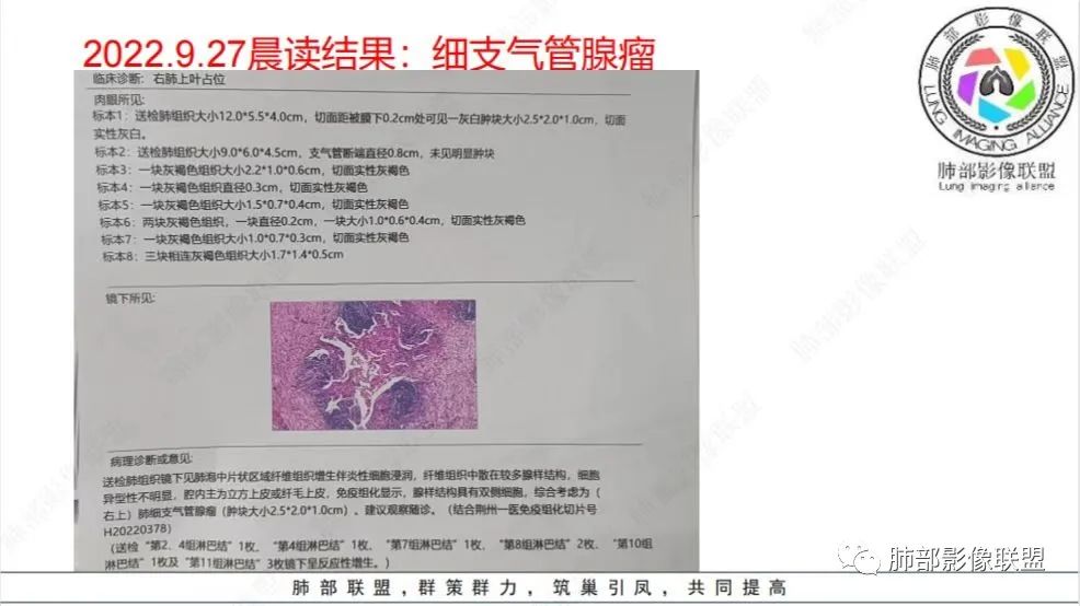影像PPT - 【病例】少见的细支气管腺瘤1例CT影像-24 影像PPT - 【病例】少见的细支气管腺瘤1例CT影像-24