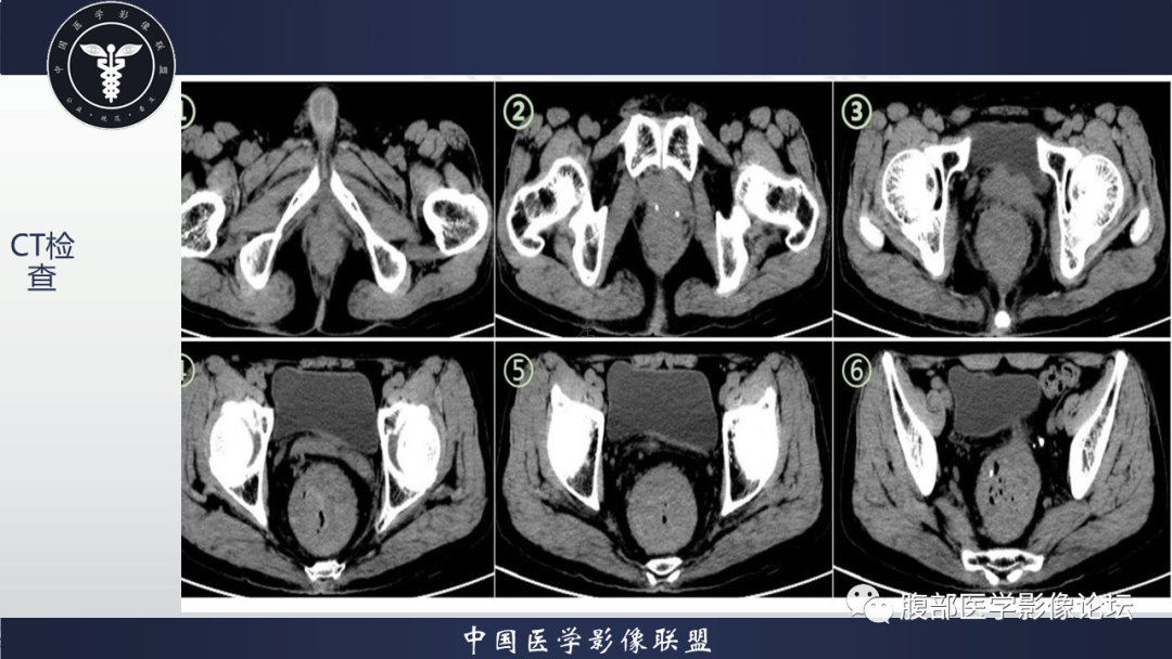 影像PPT - 【病例】直肠血管瘤1例CT及MR-3