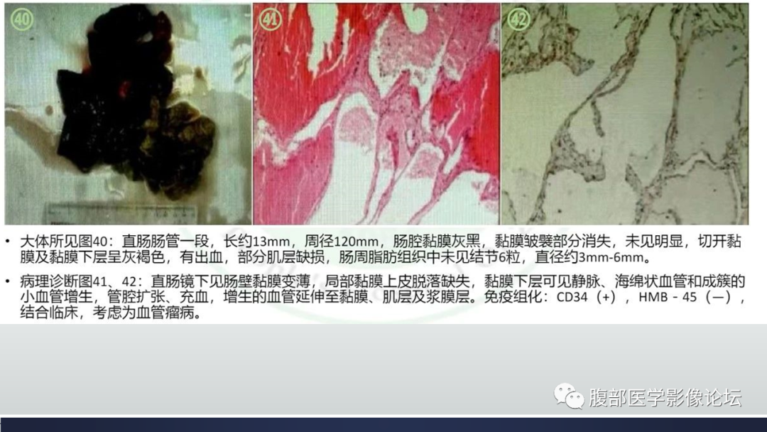 影像PPT - 【病例】直肠血管瘤1例CT及MR-11