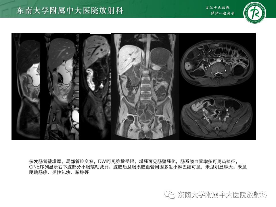 影像PPT - 【PPT】克罗恩(Crohn’s)病-3 影像PPT - 【PPT】克罗恩(Crohn’s)病-3