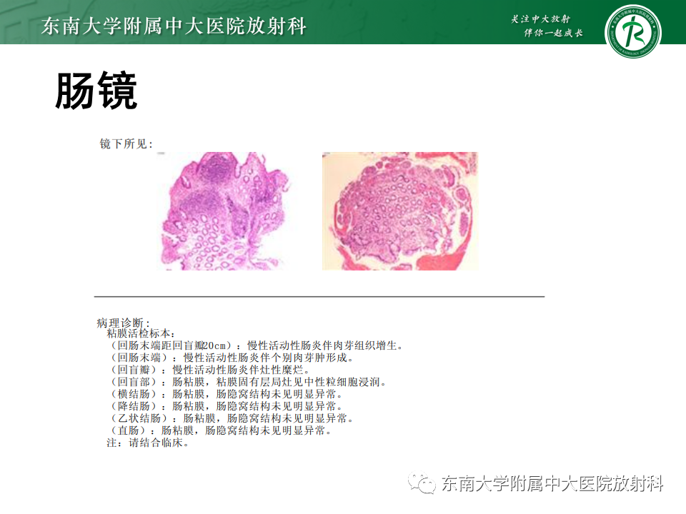 影像PPT - 【PPT】克罗恩(Crohn’s)病-4 影像PPT - 【PPT】克罗恩(Crohn’s)病-4