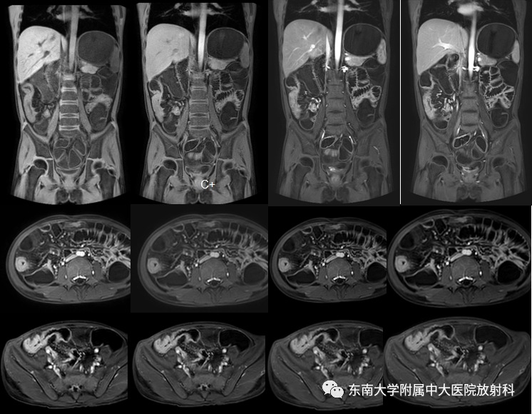 影像PPT - 【PPT】克罗恩(Crohn’s)病-2 影像PPT - 【PPT】克罗恩(Crohn’s)病-2