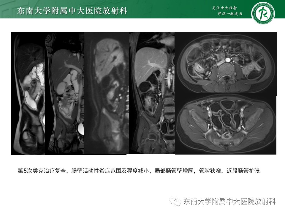 影像PPT - 【PPT】克罗恩(Crohn’s)病-5 影像PPT - 【PPT】克罗恩(Crohn’s)病-5