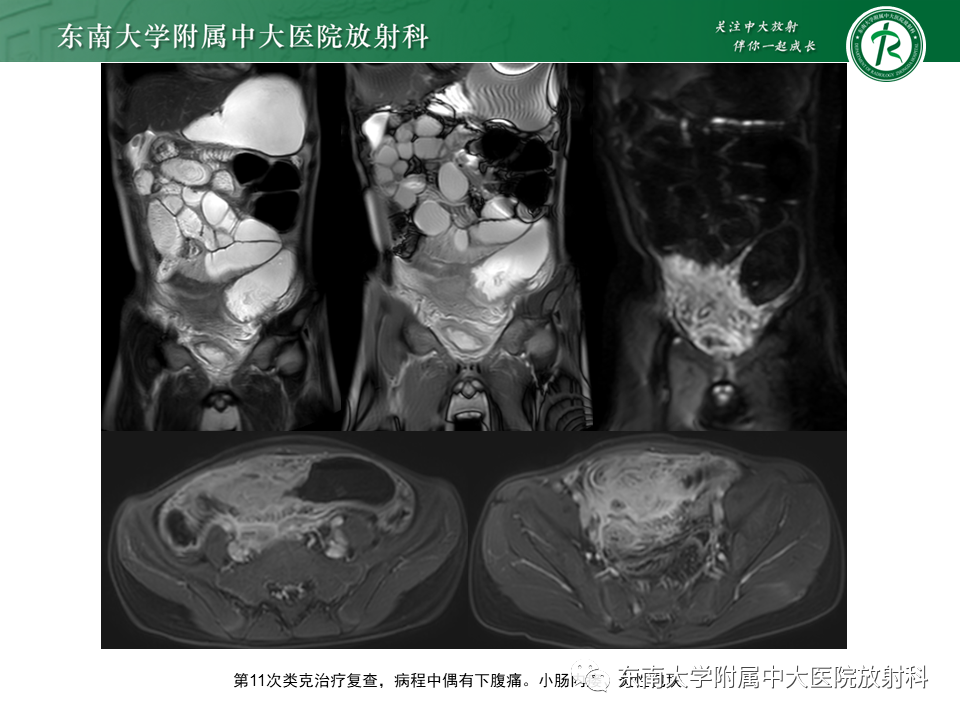 影像PPT - 【PPT】克罗恩(Crohn’s)病-6 影像PPT - 【PPT】克罗恩(Crohn’s)病-6