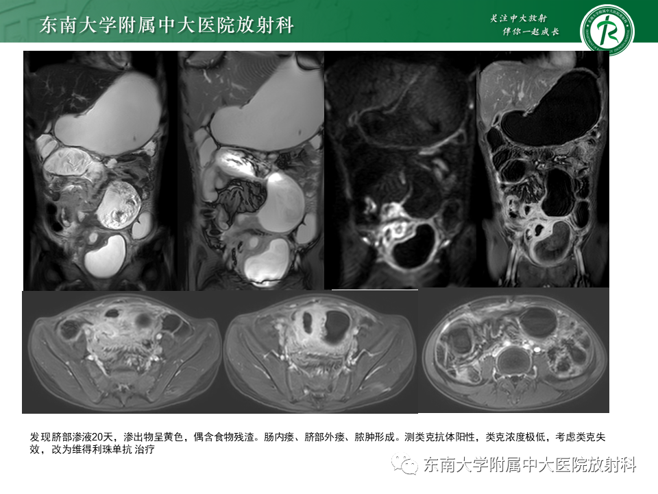 影像PPT - 【PPT】克罗恩(Crohn’s)病-7 影像PPT - 【PPT】克罗恩(Crohn’s)病-7