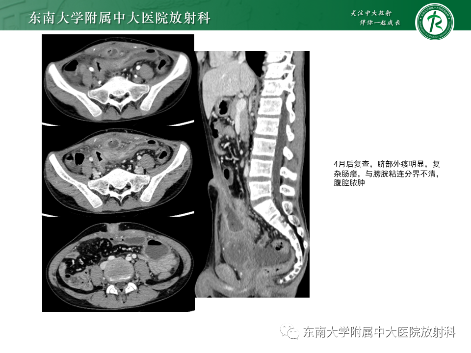 影像PPT - 【PPT】克罗恩(Crohn’s)病-8 影像PPT - 【PPT】克罗恩(Crohn’s)病-8