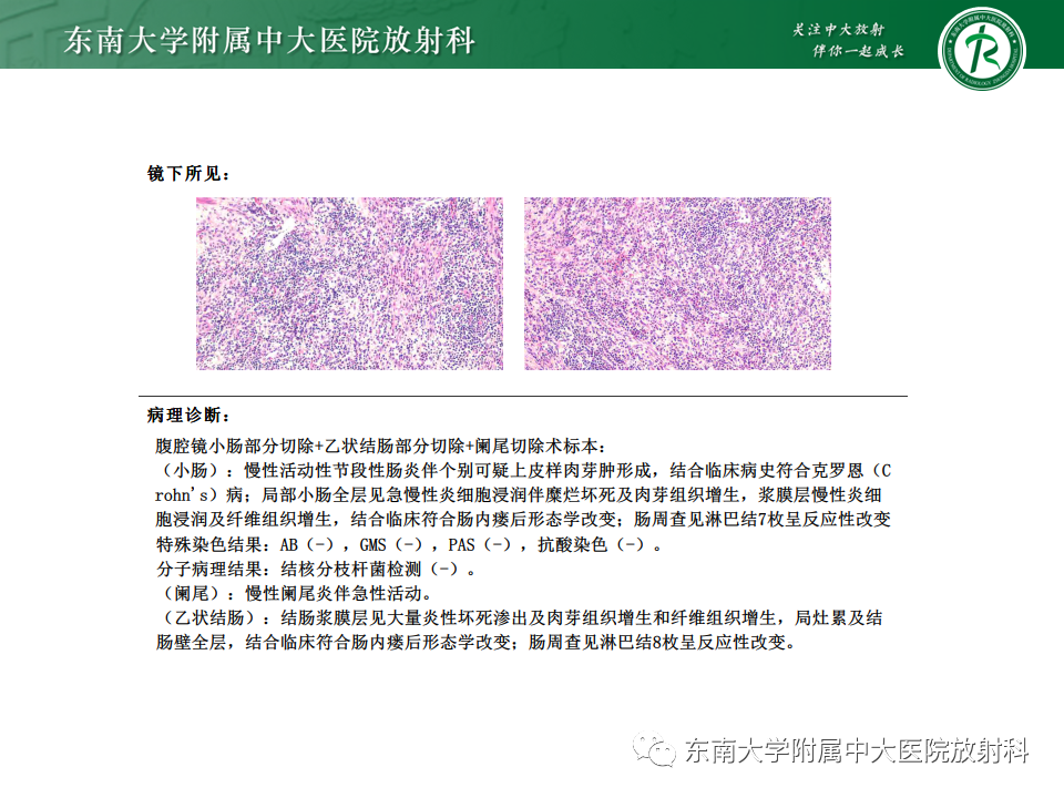 影像PPT - 【PPT】克罗恩(Crohn’s)病-10 影像PPT - 【PPT】克罗恩(Crohn’s)病-10