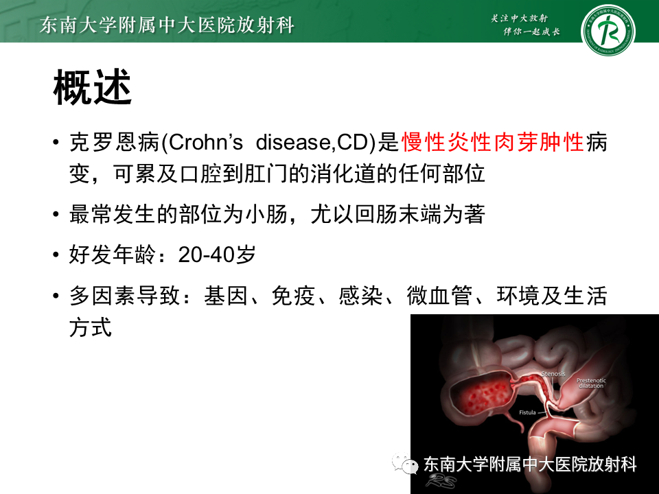 影像PPT - 【PPT】克罗恩(Crohn’s)病-12 影像PPT - 【PPT】克罗恩(Crohn’s)病-12