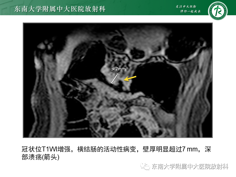 影像PPT - 【PPT】克罗恩(Crohn’s)病-22 影像PPT - 【PPT】克罗恩(Crohn’s)病-22
