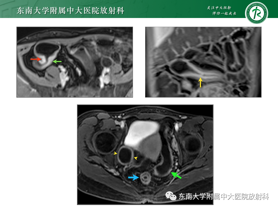 影像PPT - 【PPT】克罗恩(Crohn’s)病-24 影像PPT - 【PPT】克罗恩(Crohn’s)病-24