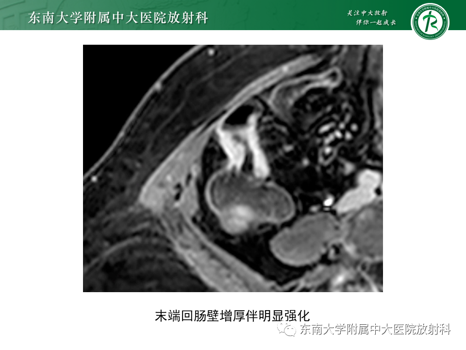 影像PPT - 【PPT】克罗恩(Crohn’s)病-25 影像PPT - 【PPT】克罗恩(Crohn’s)病-25