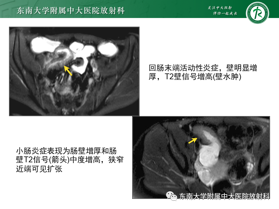 影像PPT - 【PPT】克罗恩(Crohn’s)病-27 影像PPT - 【PPT】克罗恩(Crohn’s)病-27
