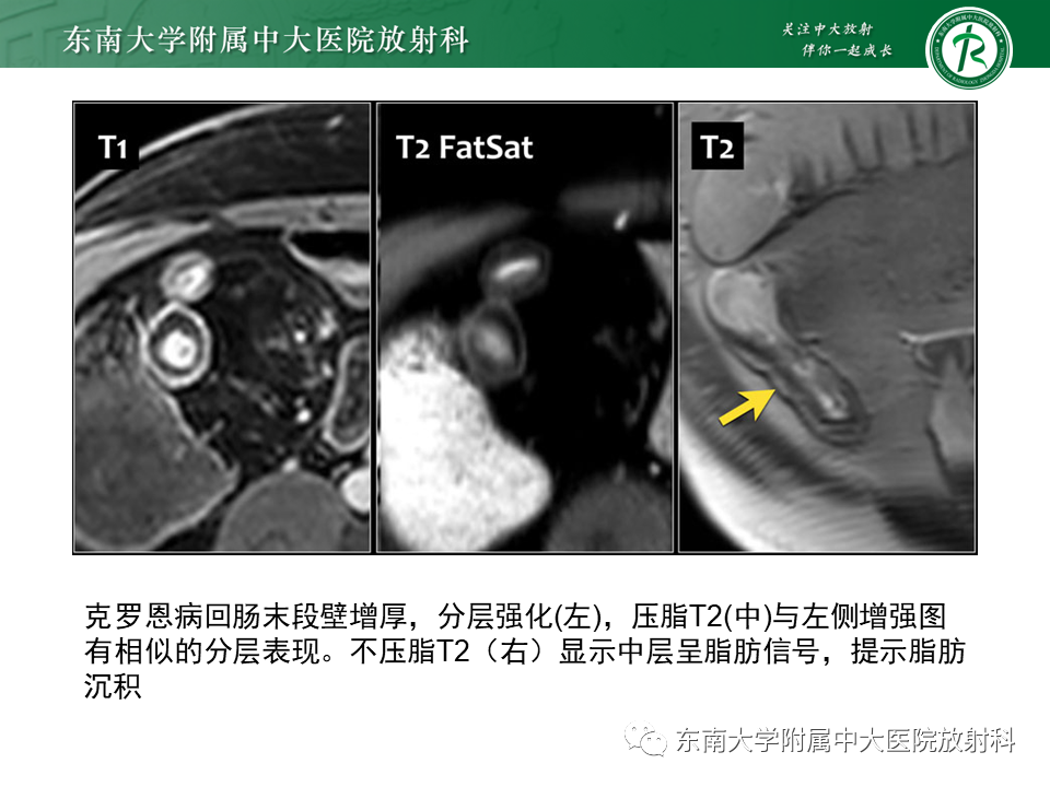 影像PPT - 【PPT】克罗恩(Crohn’s)病-28 影像PPT - 【PPT】克罗恩(Crohn’s)病-28