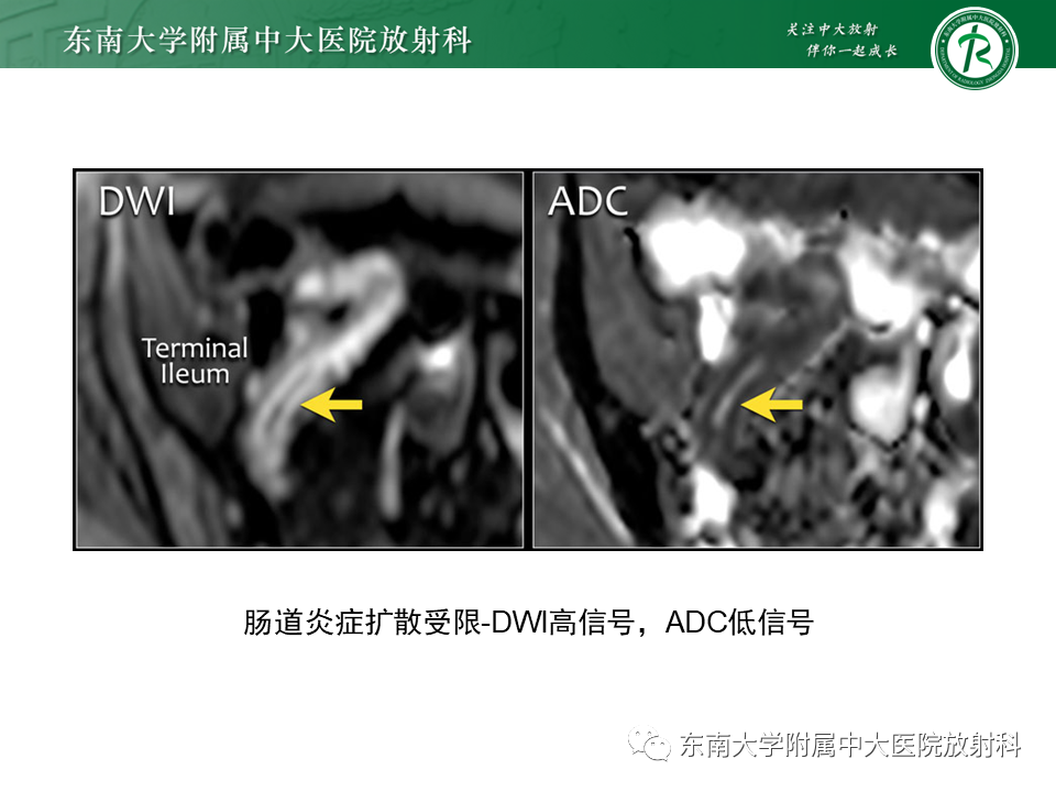 影像PPT - 【PPT】克罗恩(Crohn’s)病-29 影像PPT - 【PPT】克罗恩(Crohn’s)病-29