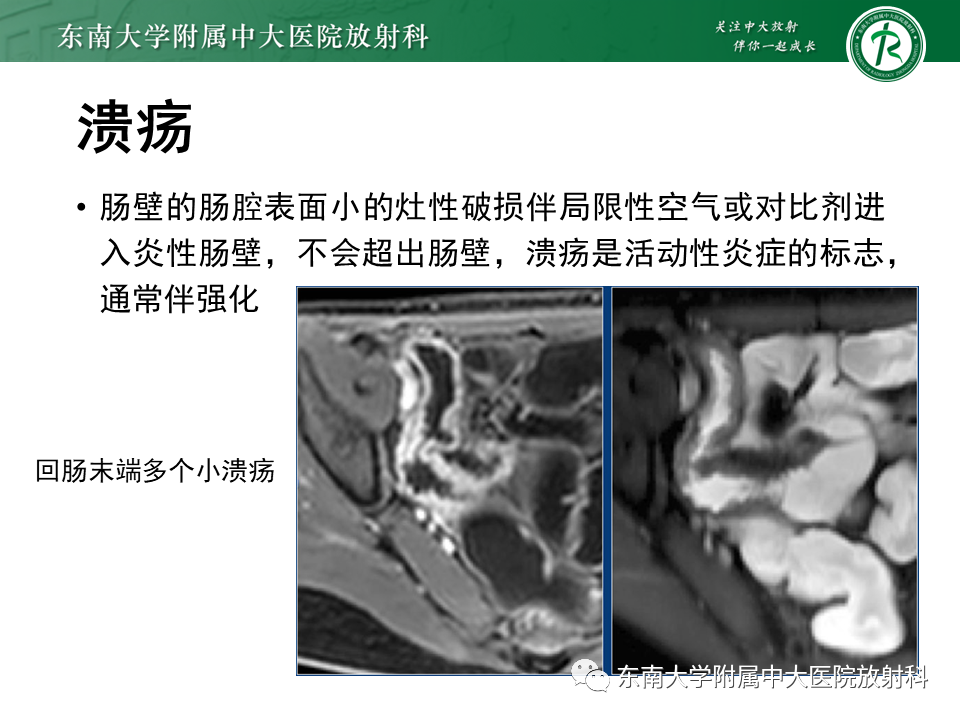 影像PPT - 【PPT】克罗恩(Crohn’s)病-30 影像PPT - 【PPT】克罗恩(Crohn’s)病-30