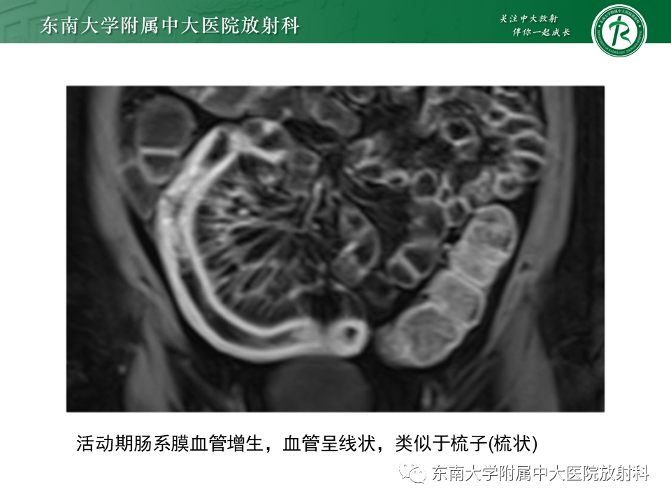 影像PPT - 【PPT】克罗恩(Crohn’s)病-32 影像PPT - 【PPT】克罗恩(Crohn’s)病-32