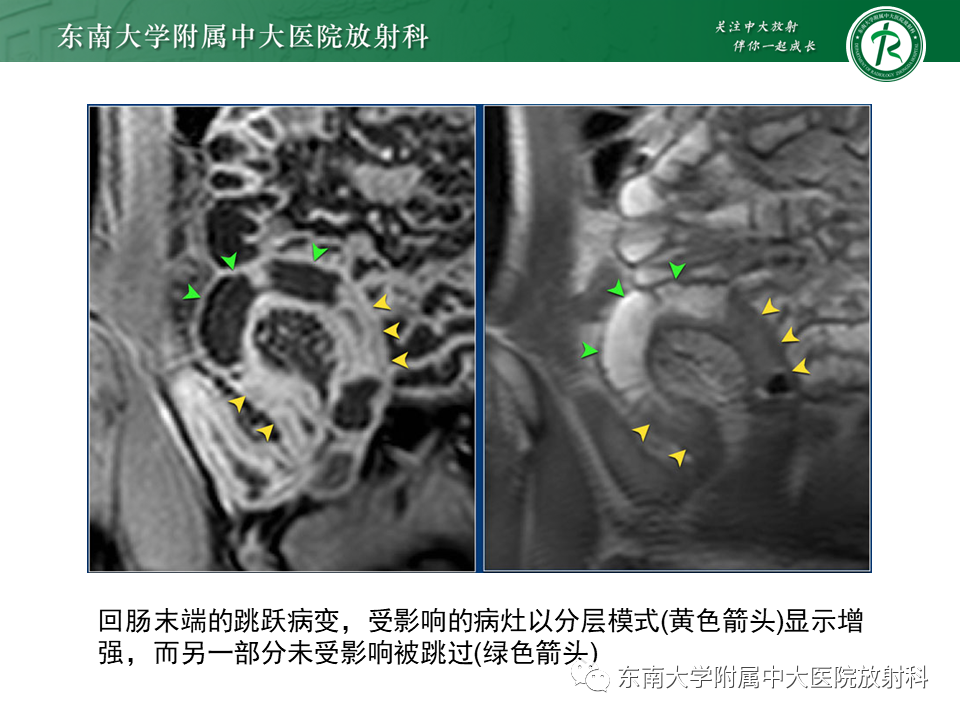 影像PPT - 【PPT】克罗恩(Crohn’s)病-34 影像PPT - 【PPT】克罗恩(Crohn’s)病-34