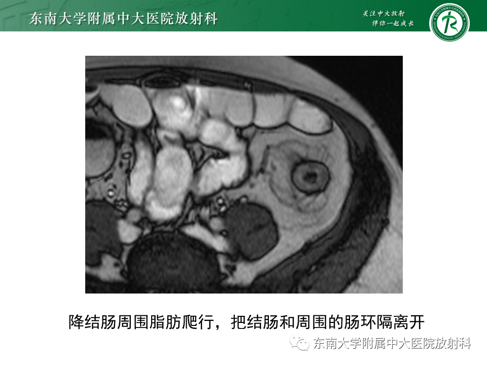 影像PPT - 【PPT】克罗恩(Crohn’s)病-33 影像PPT - 【PPT】克罗恩(Crohn’s)病-33