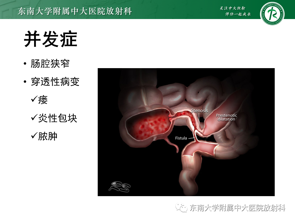 影像PPT - 【PPT】克罗恩(Crohn’s)病-35 影像PPT - 【PPT】克罗恩(Crohn’s)病-35