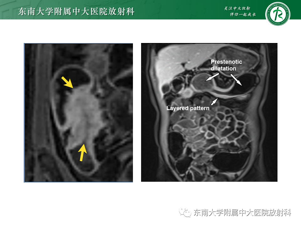 影像PPT - 【PPT】克罗恩(Crohn’s)病-37 影像PPT - 【PPT】克罗恩(Crohn’s)病-37