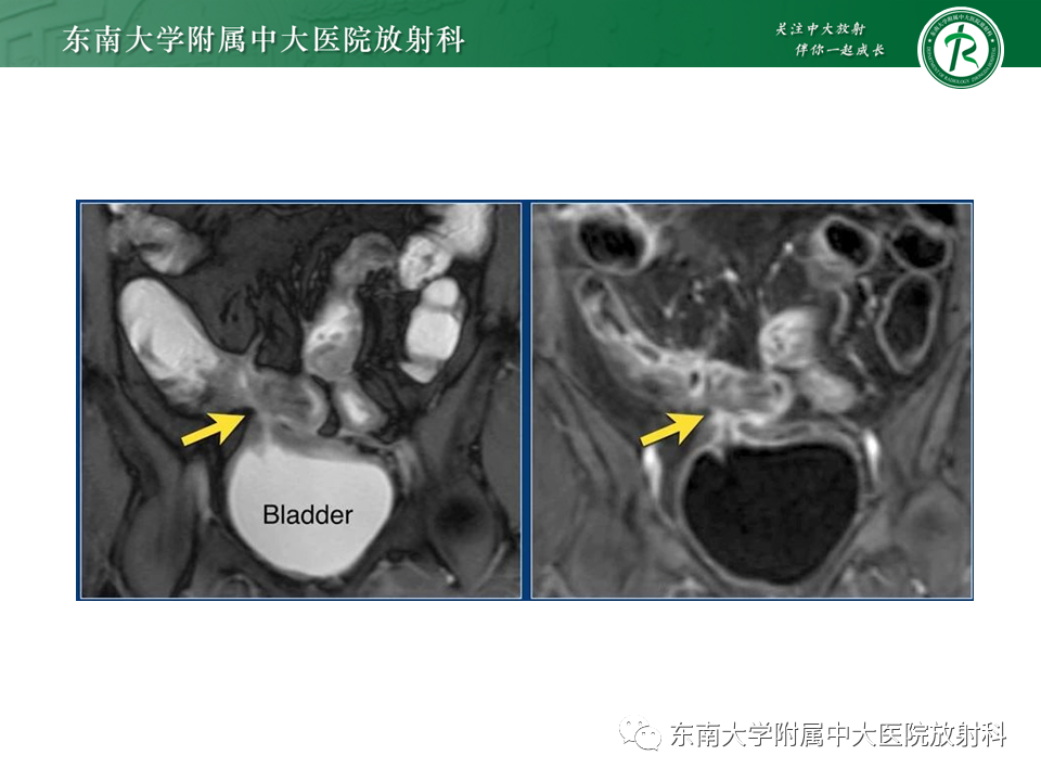 影像PPT - 【PPT】克罗恩(Crohn’s)病-39 影像PPT - 【PPT】克罗恩(Crohn’s)病-39