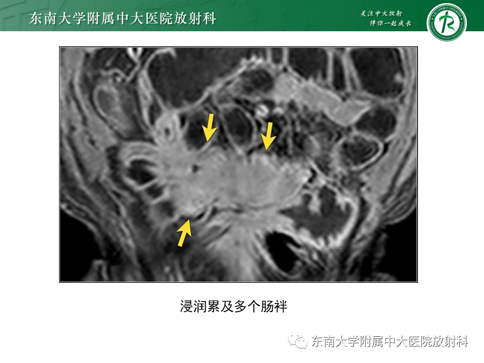 影像PPT - 【PPT】克罗恩(Crohn’s)病-40 影像PPT - 【PPT】克罗恩(Crohn’s)病-40