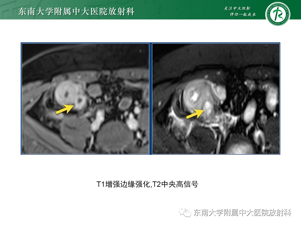 影像PPT - 【PPT】克罗恩(Crohn’s)病-41 影像PPT - 【PPT】克罗恩(Crohn’s)病-41