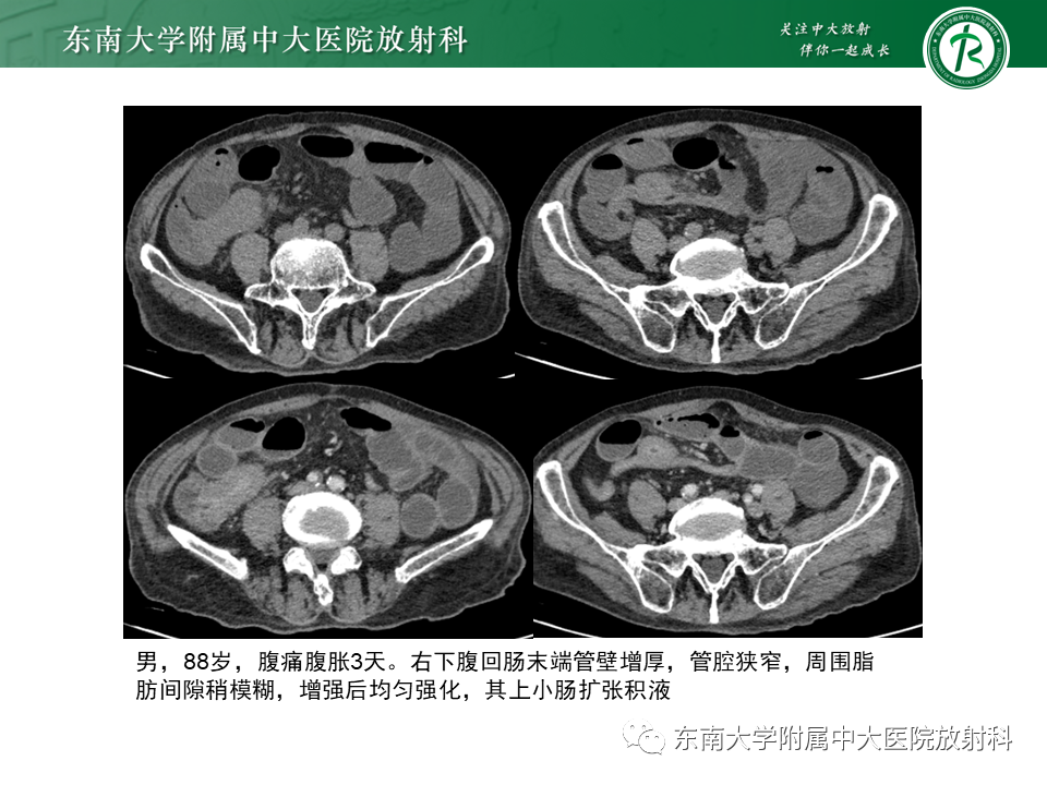 影像PPT - 【PPT】克罗恩(Crohn’s)病-44 影像PPT - 【PPT】克罗恩(Crohn’s)病-44