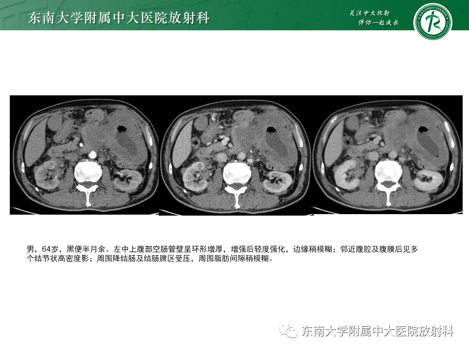 影像PPT - 【PPT】克罗恩(Crohn’s)病-47 影像PPT - 【PPT】克罗恩(Crohn’s)病-47