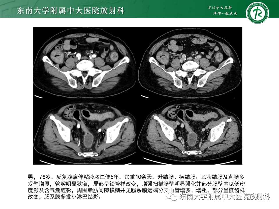 影像PPT - 【PPT】克罗恩(Crohn’s)病-51 影像PPT - 【PPT】克罗恩(Crohn’s)病-51
