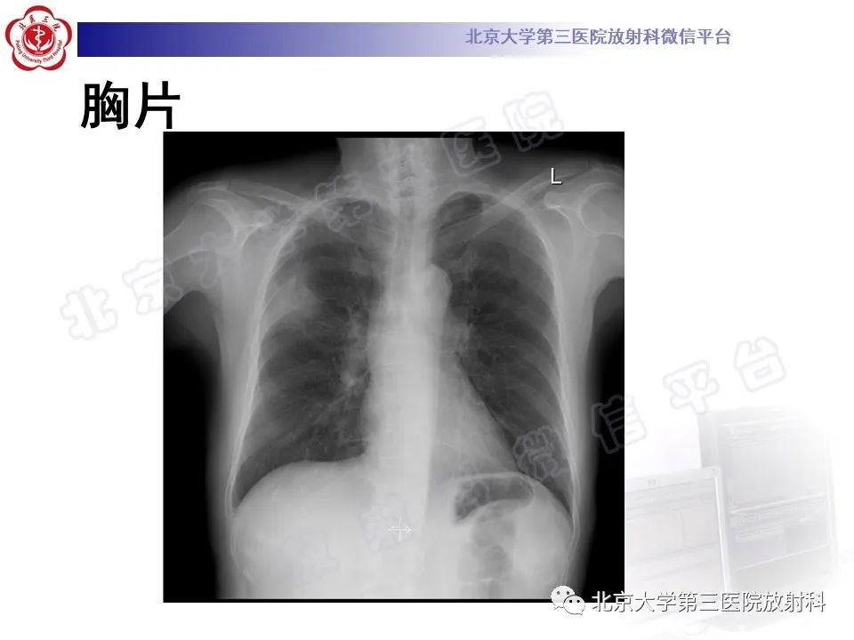 影像PPT - 【PPT】肺放线菌病-3