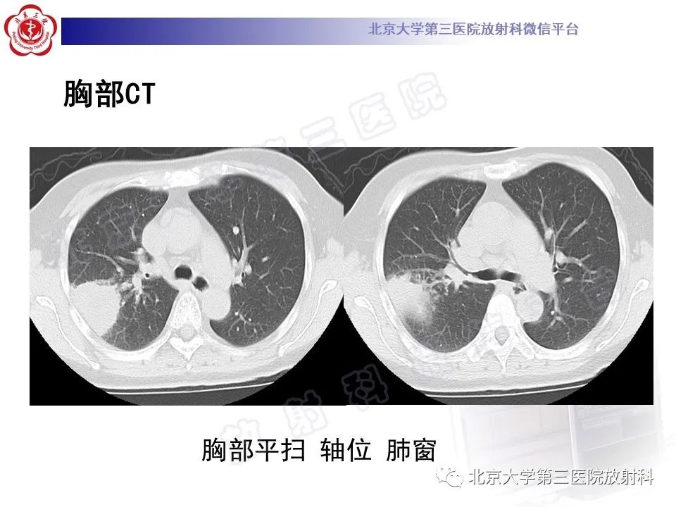 影像PPT - 【PPT】肺放线菌病-4
