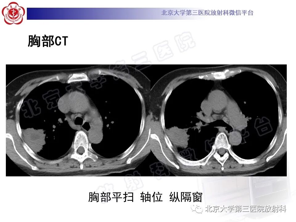 影像PPT - 【PPT】肺放线菌病-5