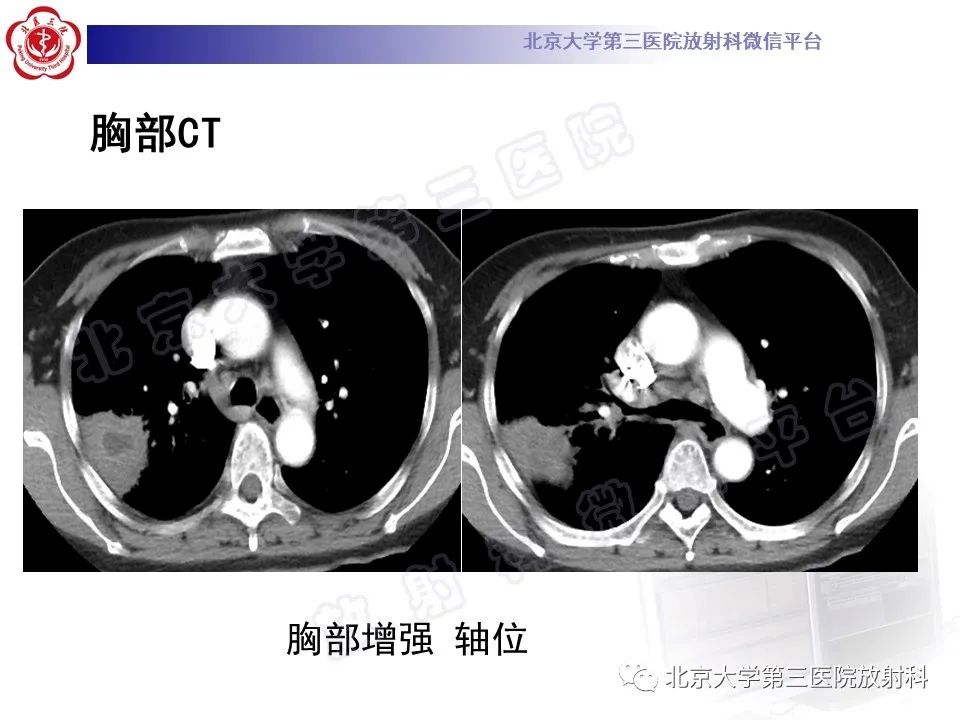 影像PPT - 【PPT】肺放线菌病-6