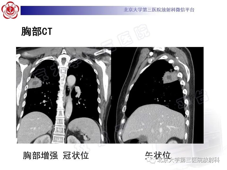 影像PPT - 【PPT】肺放线菌病-7