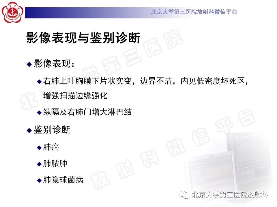影像PPT - 【PPT】肺放线菌病-8