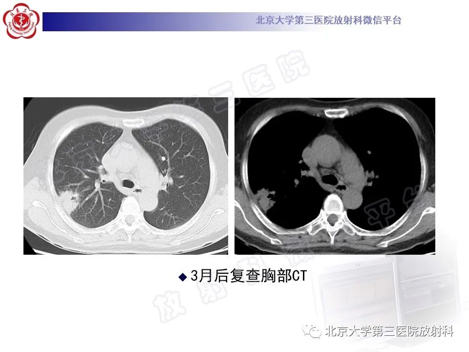 影像PPT - 【PPT】肺放线菌病-11