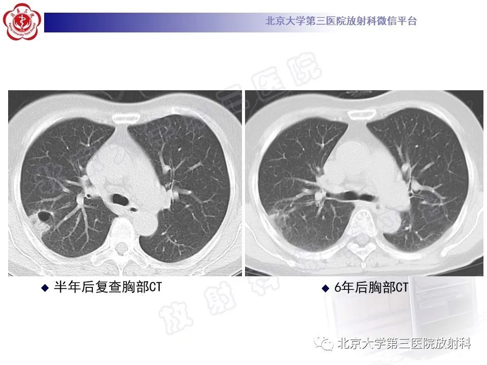 影像PPT - 【PPT】肺放线菌病-12
