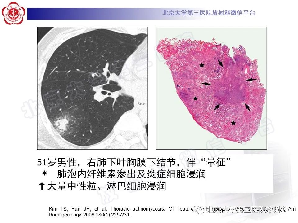影像PPT - 【PPT】肺放线菌病-22