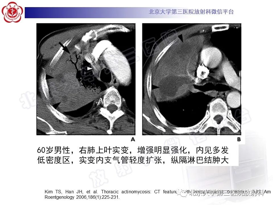 影像PPT - 【PPT】肺放线菌病-24