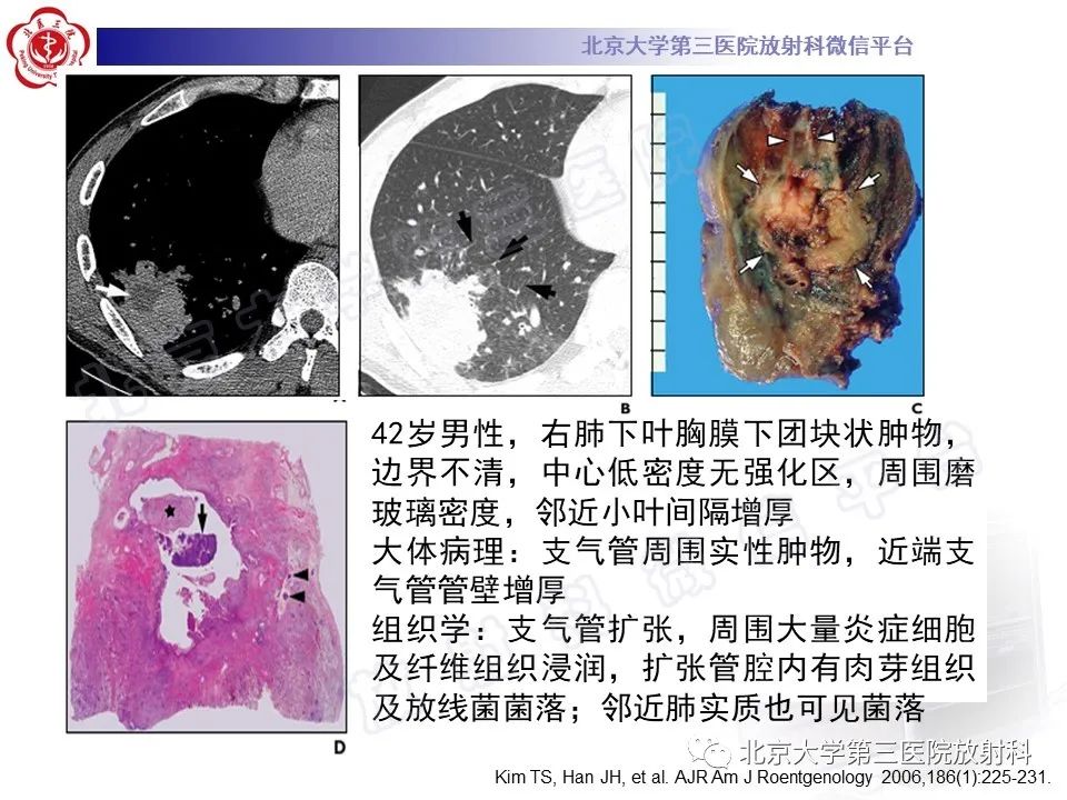 影像PPT - 【PPT】肺放线菌病-23