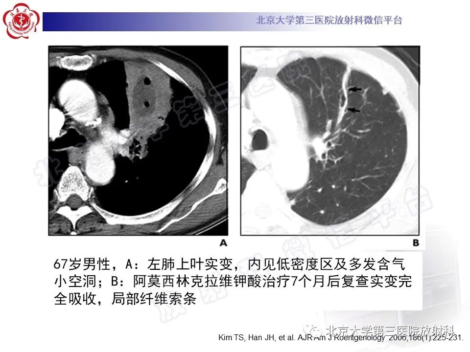 影像PPT - 【PPT】肺放线菌病-25