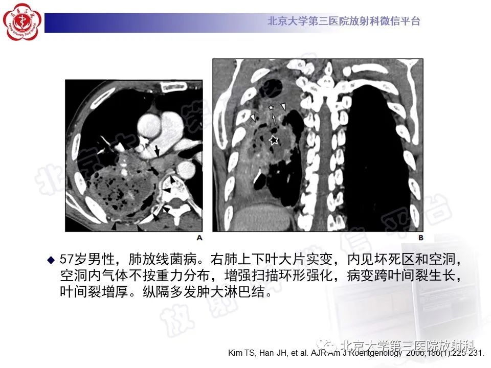 影像PPT - 【PPT】肺放线菌病-26