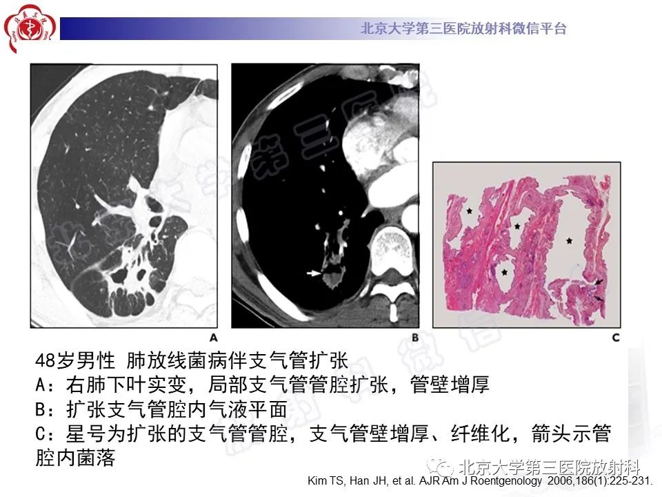 影像PPT - 【PPT】肺放线菌病-27